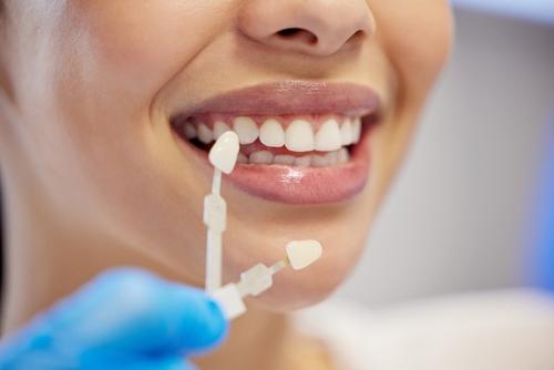 dental crowns
