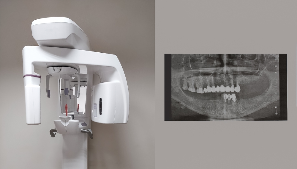 digital dental xray machine