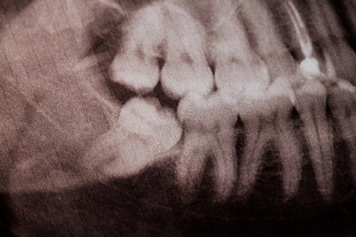 wisdom tooth xray