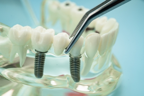 dental implants example