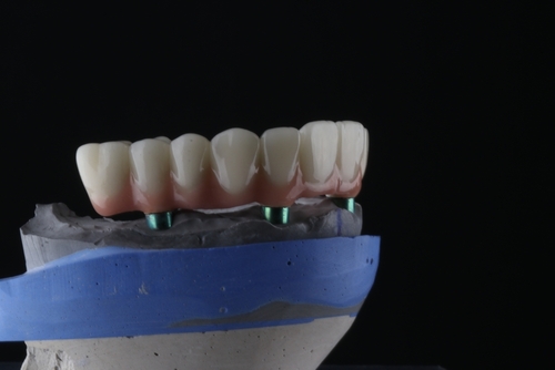 full arch dental implant