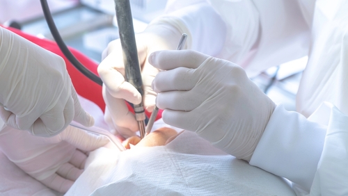 wisdom tooth surgery