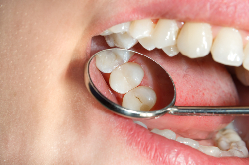 Dental Sealants in Burbank