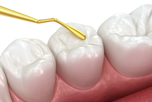 sealants for molars