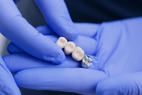 dental bridge held by dentist