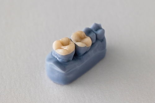 dental inlay