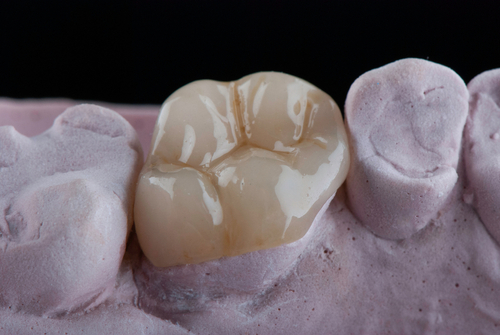 dental onlay