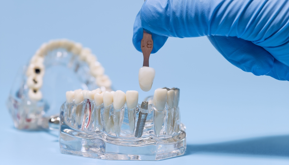 how long do dental implants take