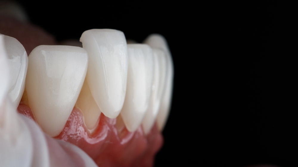 how much veneers cost