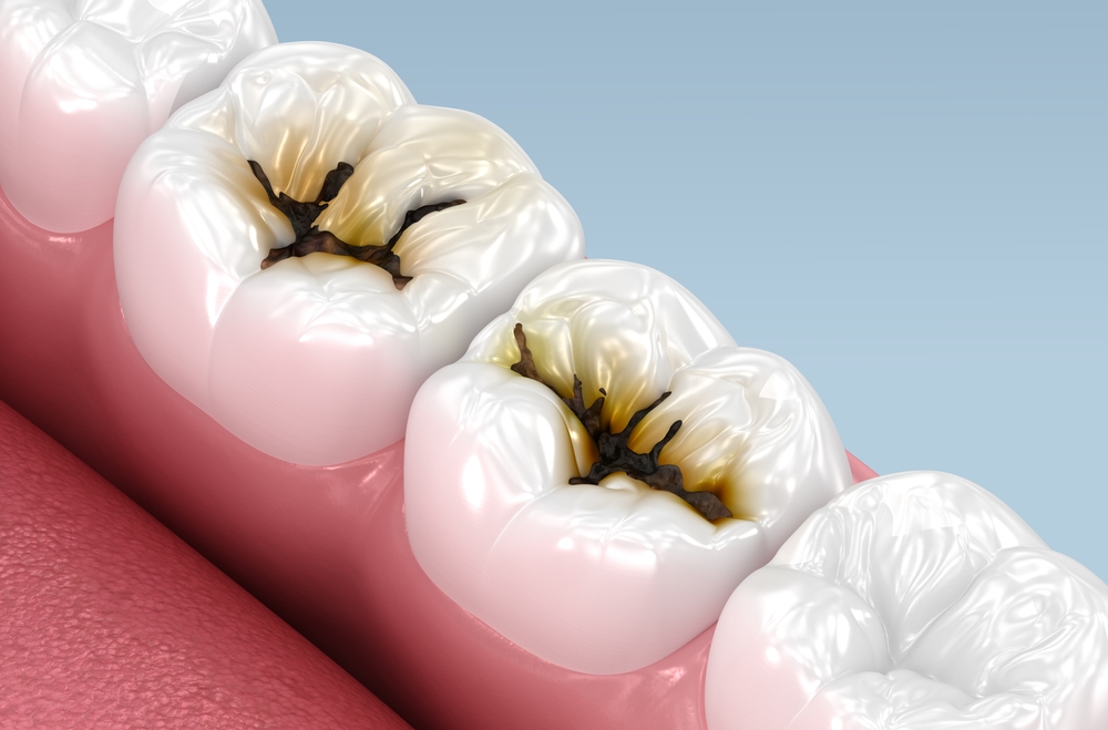 what cavity feels like