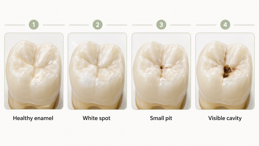 cavity progression