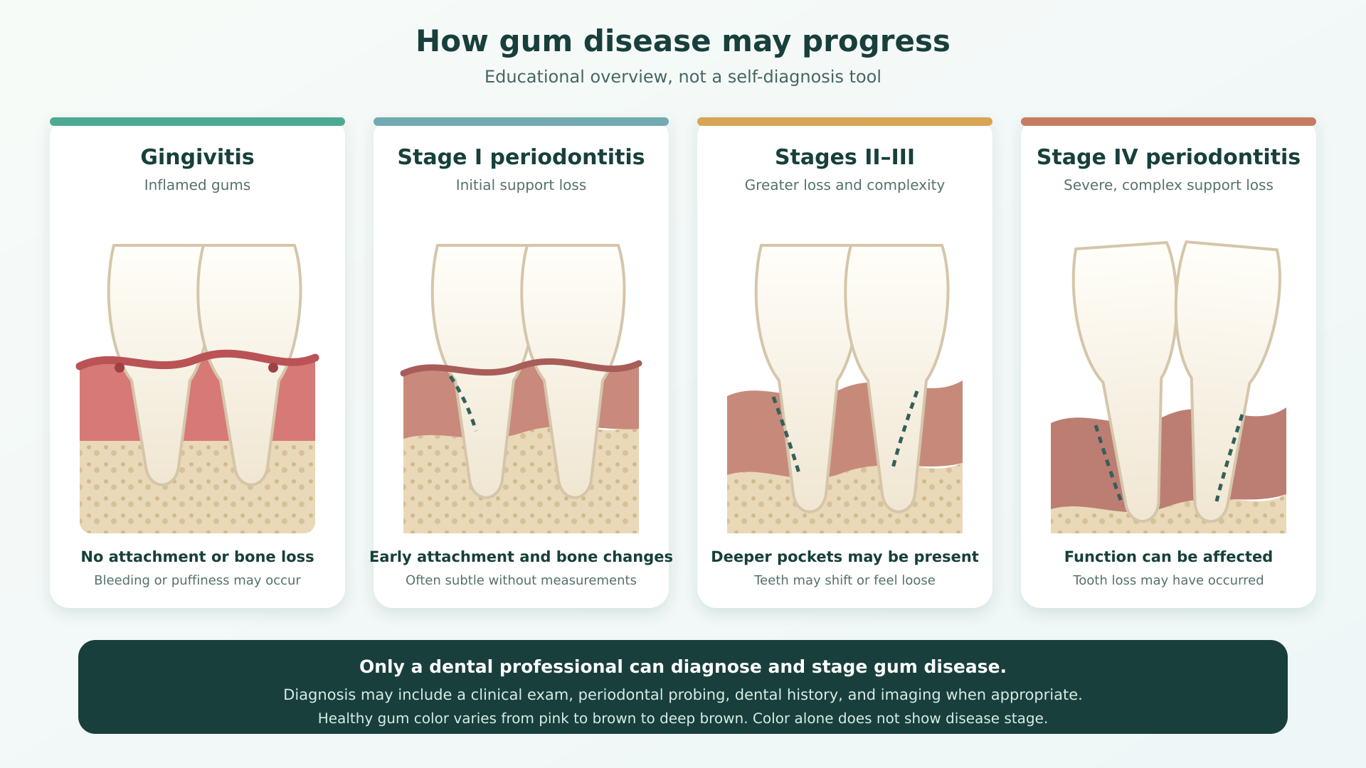 Diagram comparing gingivitis with periodontitis stages I through IV.